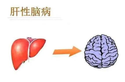 脑肝肾综合征,病因、症状、诊断与治疗概述